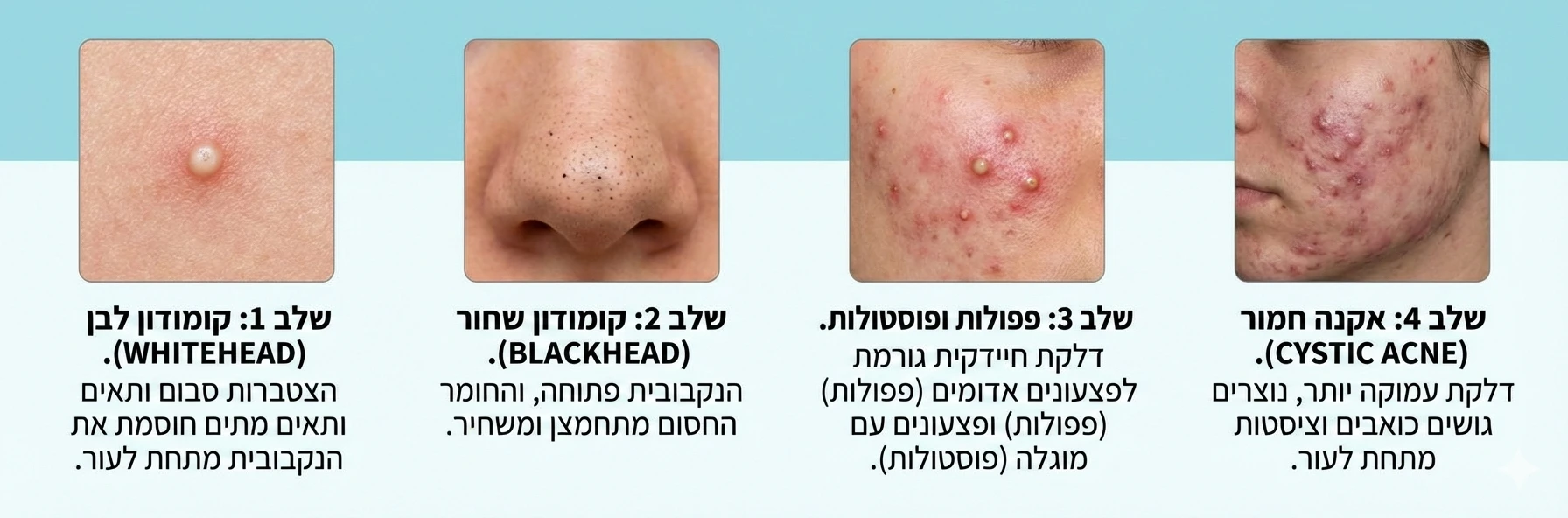 שלב אחרי שלב בהתפתחות של אקנה.. מקומדון עד לאקנה — מכון יופי ביוטי זיו