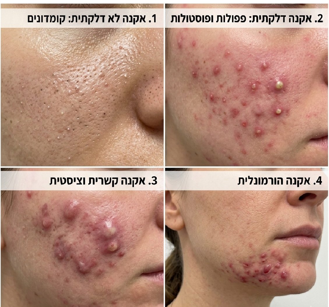 לא רק "פצעים": המדריך המלא לסוגי אקנה והדרכים לטיפול